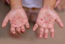  Hand, Foot, and Mouth Disease (HFMD)