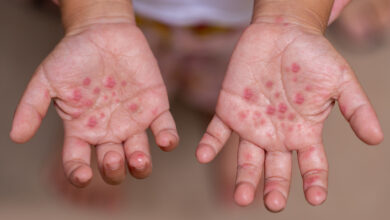  Hand, Foot, and Mouth Disease (HFMD)
