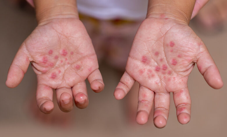  Hand, Foot, and Mouth Disease (HFMD)